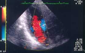 Farbdoppler- Ultraschalluntersuchung des Herzens